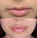 KIT LIPFINITY 2.0 - Microneedling labbra