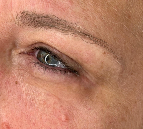 EyeFix Contorno occhi istantaneo